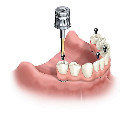 Dental Implants